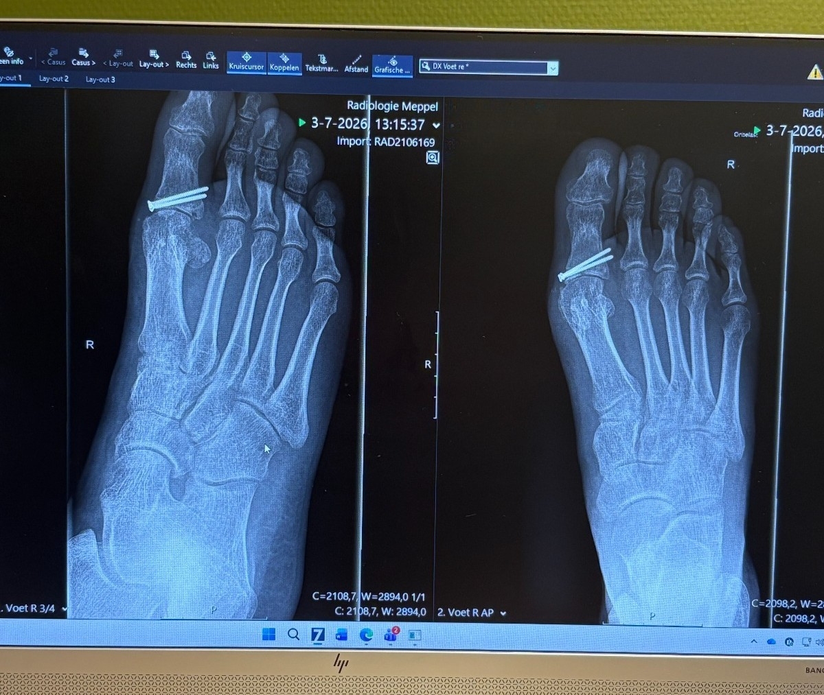 Revalidatie na het gips